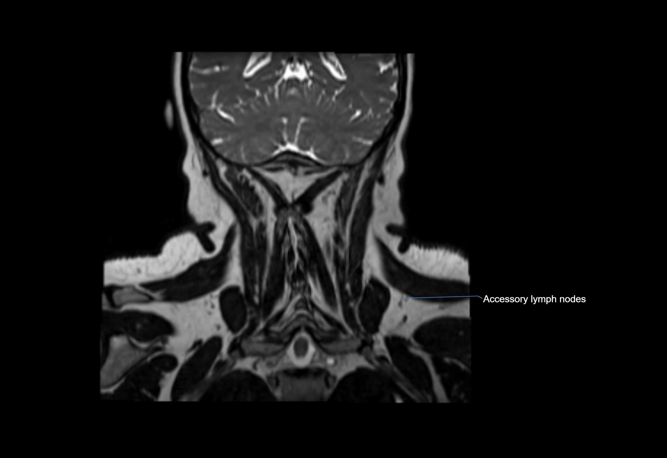 Neck coronal lymph node cross sectional MRI anatomy 3T MRI  image-img-00001-00014.webp